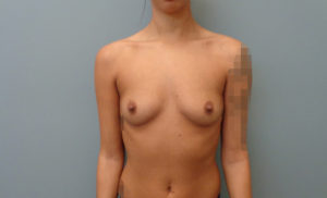 Breast Augmentation Before & After Pictures in Nashville, TN