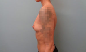 Breast Augmentation Before & After Pictures in Nashville, TN