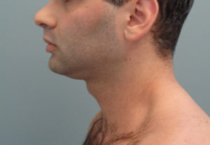 Chin Implant Before & After Pictures in Nashville, TN