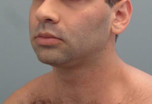 Chin Implant Before & After Pictures in Nashville, TN