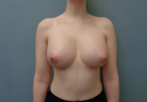 Breast Augmentation Before & After Pictures in Nashville, TN