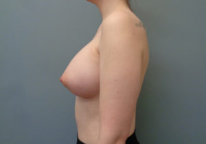 Breast Augmentation Before & After Pictures in Nashville, TN