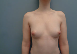 Breast Augmentation Before & After Pictures in Nashville, TN