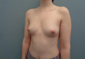 Breast Augmentation Before & After Pictures in Nashville, TN