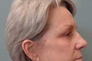 Blepharoplasty Before & After Pictures in Nashville, TN