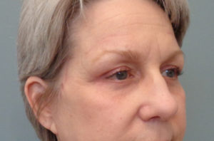 Blepharoplasty Before & After Pictures in Nashville, TN