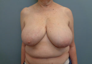 Implant Based reconstruction Before & After Pictures in Nashville, TN