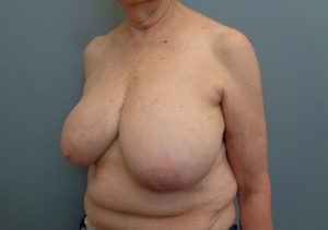 Implant Based reconstruction Before & After Pictures in Nashville, TN