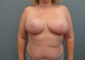 Implant Based reconstruction Before & After Pictures in Nashville, TN