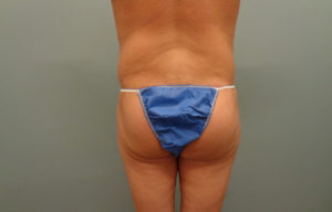 Butt augmentation Before & After Pictures in Nashville, TN