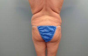 Butt augmentation Before & After Pictures in Nashville, TN