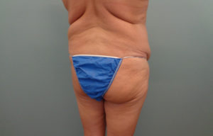 Butt augmentation Before & After Pictures in Nashville, TN