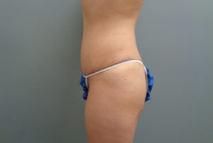 Tummy Tuck Before & After Pictures in Nashville, TN