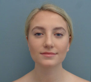 Rhinoplasty Before & After Pictures in Nashville, TN