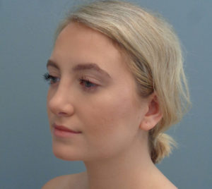 Rhinoplasty Before & After Pictures in Nashville, TN