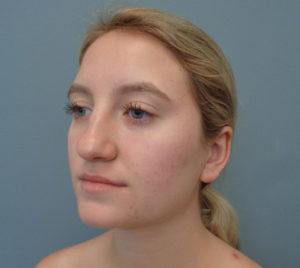 Rhinoplasty Before & After Pictures in Nashville, TN