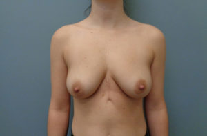 Breast Augmentation with Lift Before & After Pictures in Nashville, TN