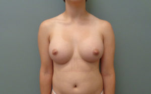 Breast Augmentation Before & After Pictures in Nashville, TN