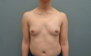 Breast Augmentation Before & After Pictures in Nashville, TN