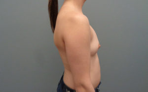 Breast Augmentation Before & After Pictures in Nashville, TN