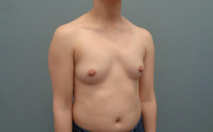 Breast Augmentation Before & After Pictures in Nashville, TN