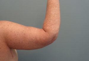 Arm Lift Before & After Pictures in Nashville, TN