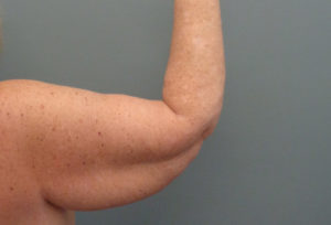 Arm Lift Before & After Pictures in Nashville, TN