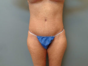 Tummy Tuck Before & After Pictures in Nashville, TN