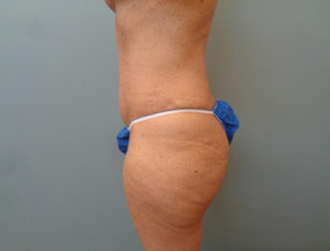 Tummy Tuck Before & After Pictures in Nashville, TN