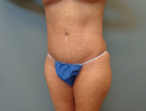 Tummy Tuck Before & After Pictures in Nashville, TN