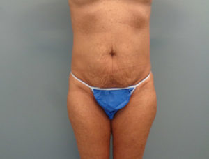 Tummy Tuck Before & After Pictures in Nashville, TN