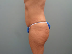 Tummy Tuck Before & After Pictures in Nashville, TN