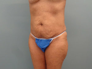 Tummy Tuck Before & After Pictures in Nashville, TN