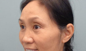 Blepharoplasty Before & After Pictures in Nashville, TN