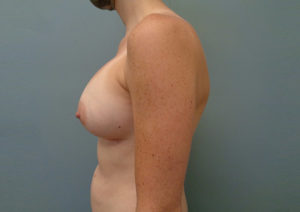 Breast Augmentation Before & After Pictures in Nashville, TN