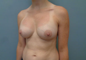 Breast Augmentation Before & After Pictures in Nashville, TN