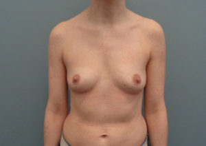 Breast Augmentation Before & After Pictures in Nashville, TN