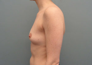 Breast Augmentation Before & After Pictures in Nashville, TN