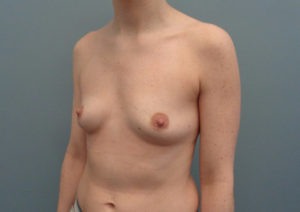 Breast Augmentation Before & After Pictures in Nashville, TN