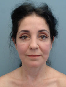 Facelift Before & After Pictures in Nashville, TN