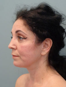 Facelift Before & After Pictures in Nashville, TN