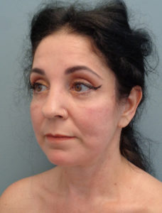 Facelift Before & After Pictures in Nashville, TN