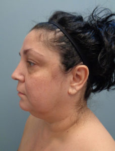 Facelift Before & After Pictures in Nashville, TN