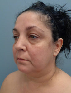 Facelift Before & After Pictures in Nashville, TN