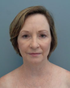 Facelift Before and After Pictures Nashville, TN