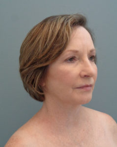 Facelift Before and After Pictures Nashville, TN