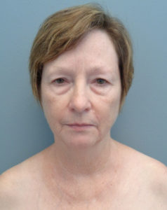 Facelift Before and After Pictures Nashville, TN