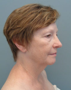 Facelift Before and After Pictures Nashville, TN