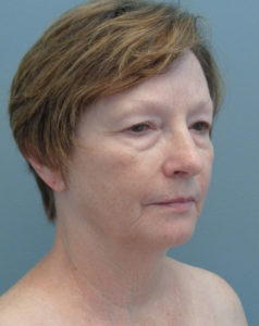 Facelift Before and After Pictures Nashville, TN