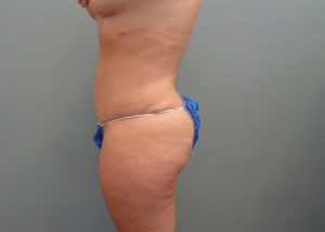 Abdominoplasty Before & After Pictures in Nashville, TN